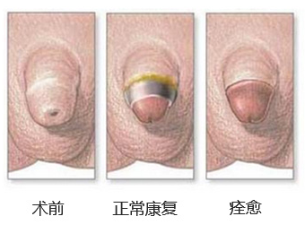 包皮5.png