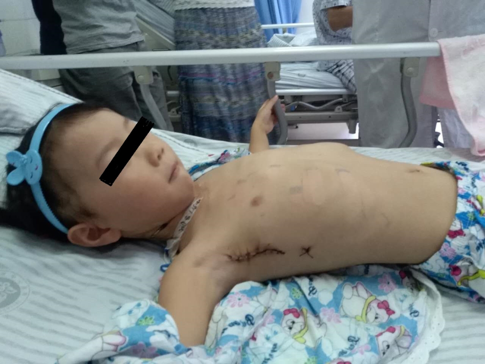 3岁小儿先心病腋下小切口心脏手术.png