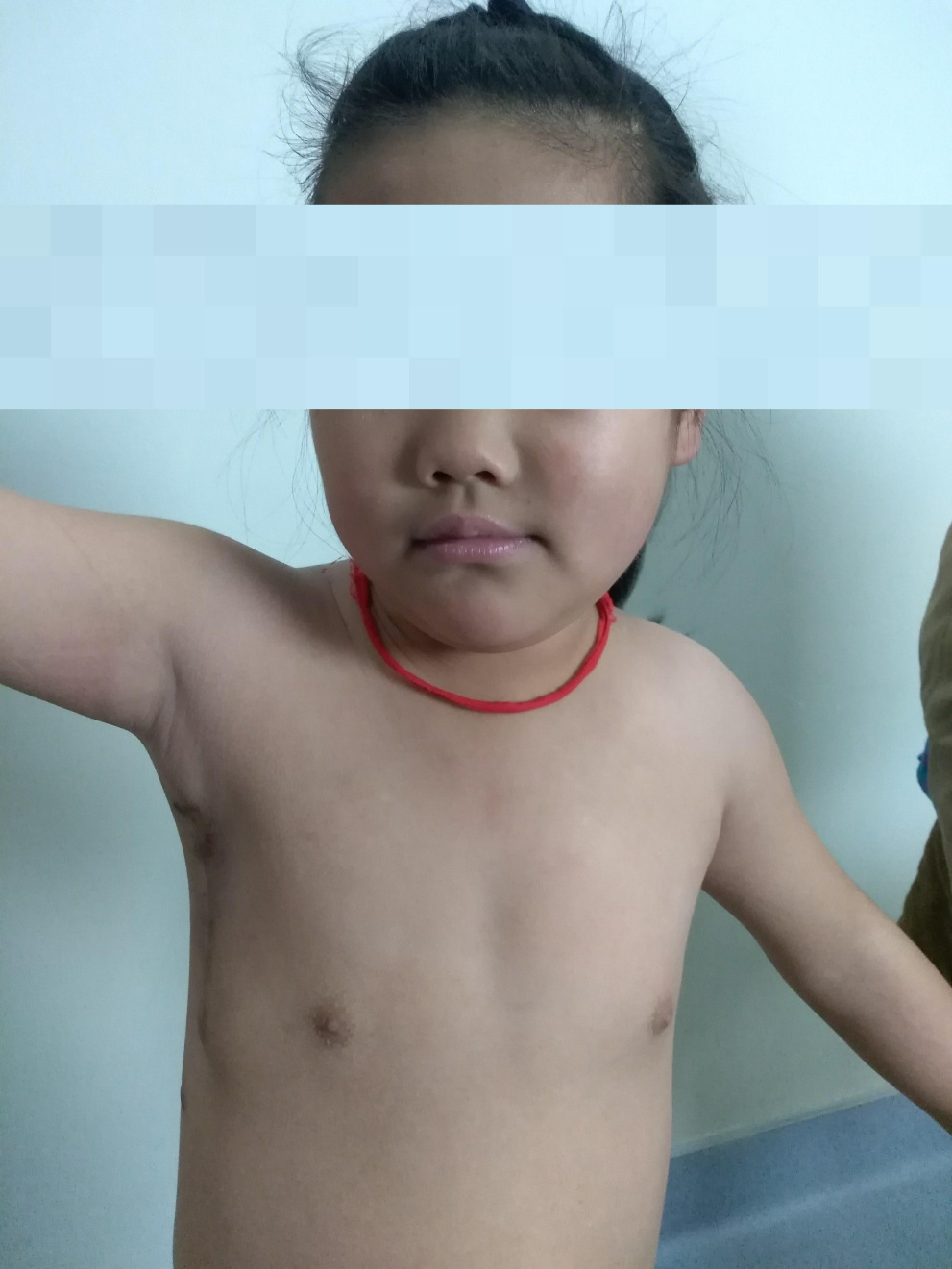 14岁小儿先心病腋下小切口心脏手术术后3月.png